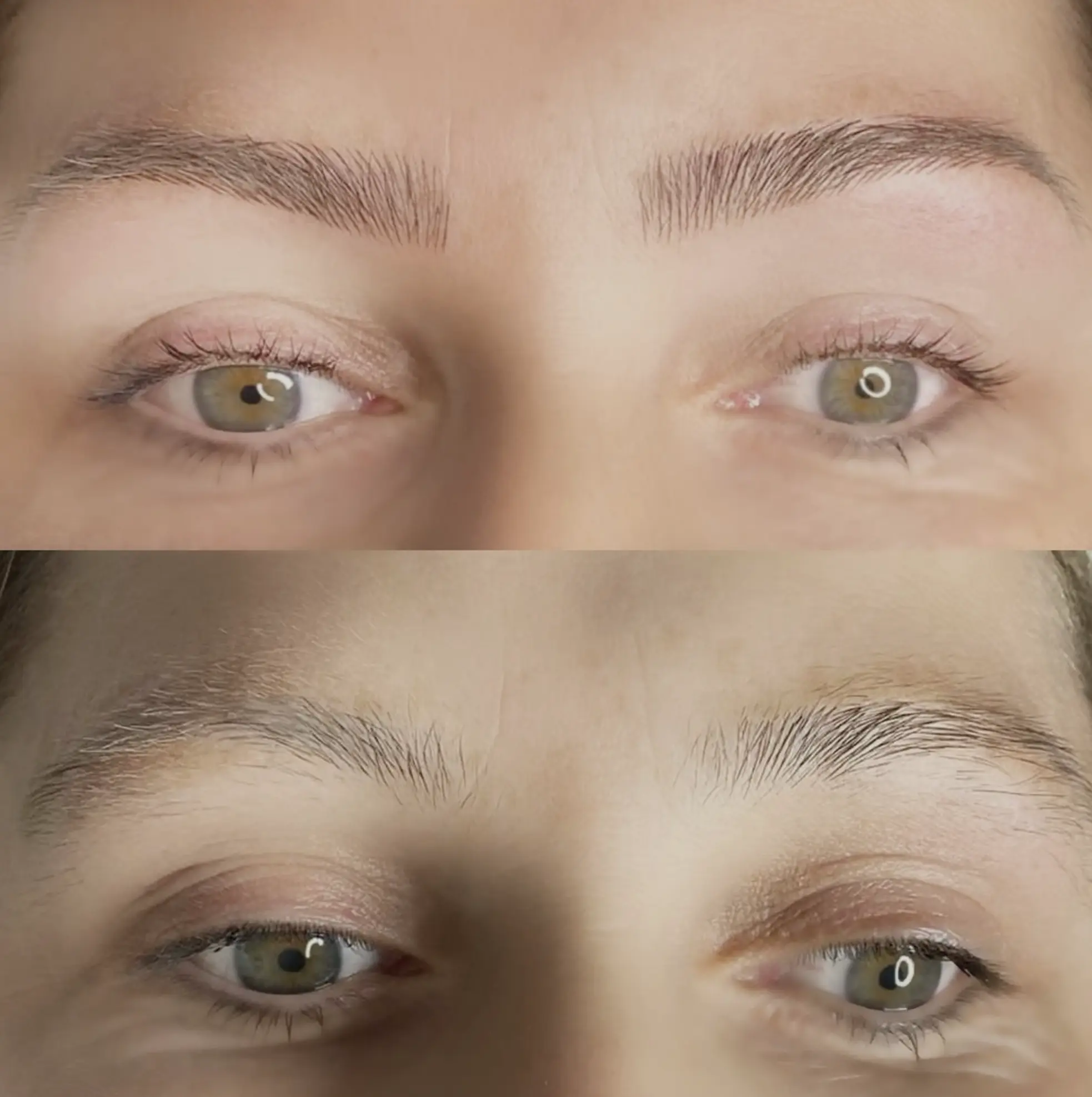 eyebrow tattoo removal Melbourne